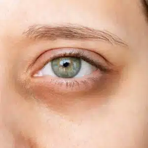 Close-up of the eye contour area showing bluish dark circles.